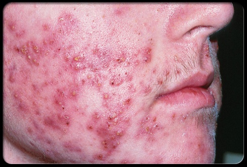 real person with real cystic acne