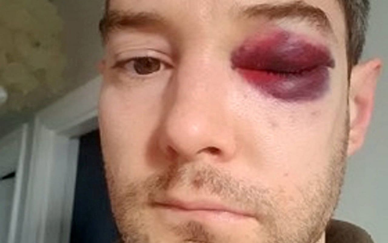 Police criticise 'soft' sentence for thug who broke officer's eye socket